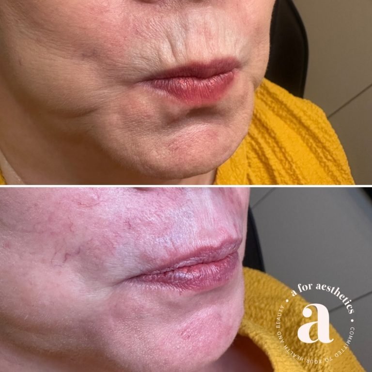 A for Aesthetics — genuine patient before and after