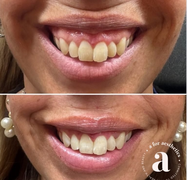 A for Aesthetics — genuine patient before and after