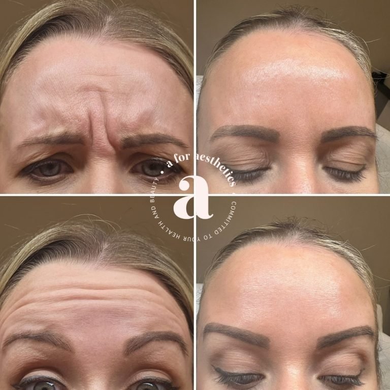 A for Aesthetics — genuine patient before and after