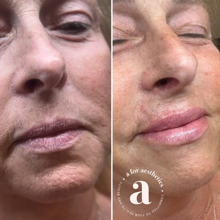 A for Aesthetics — genuine patient before and after