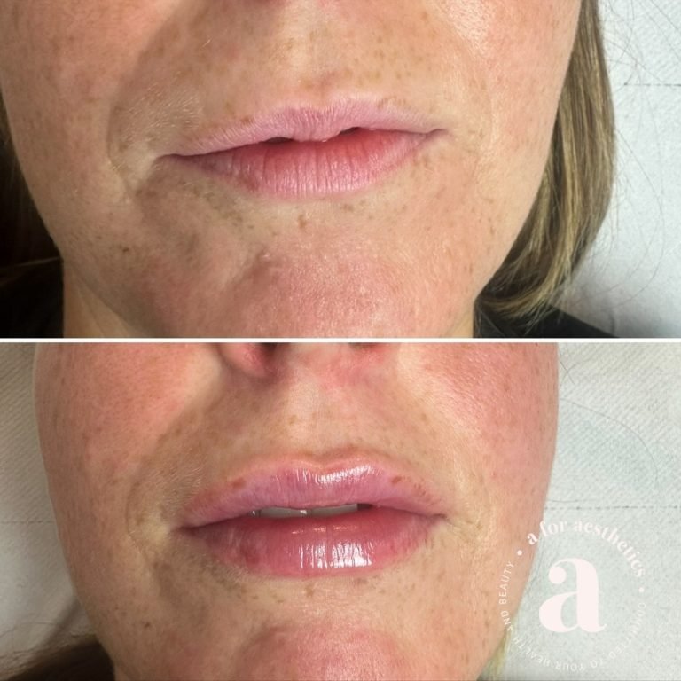 A for Aesthetics — genuine patient before and after