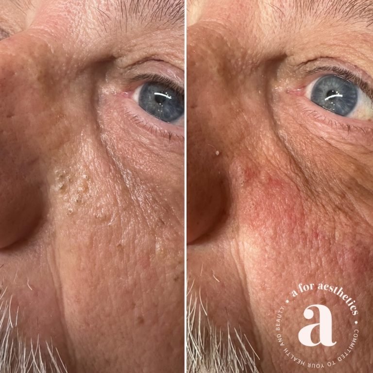 A for Aesthetics — genuine patient before and after