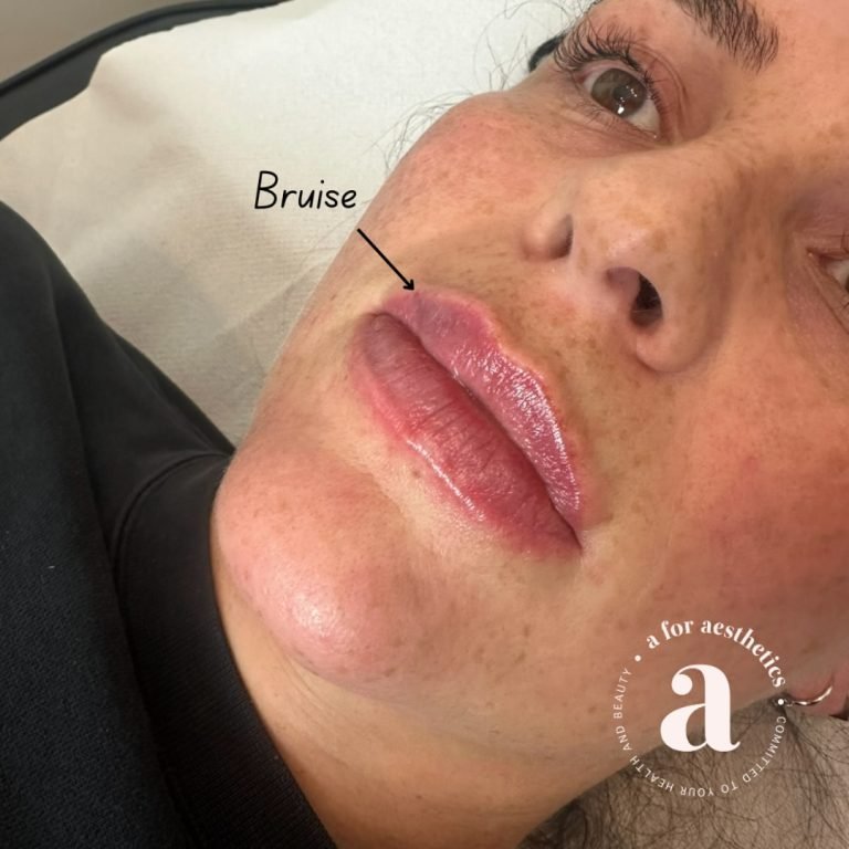 A for Aesthetics — genuine patient before and after