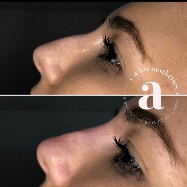 A for Aesthetics — genuine patient before and after