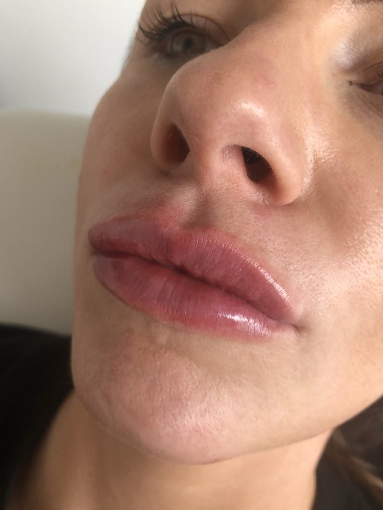 A for Aesthetics — genuine patient before and after